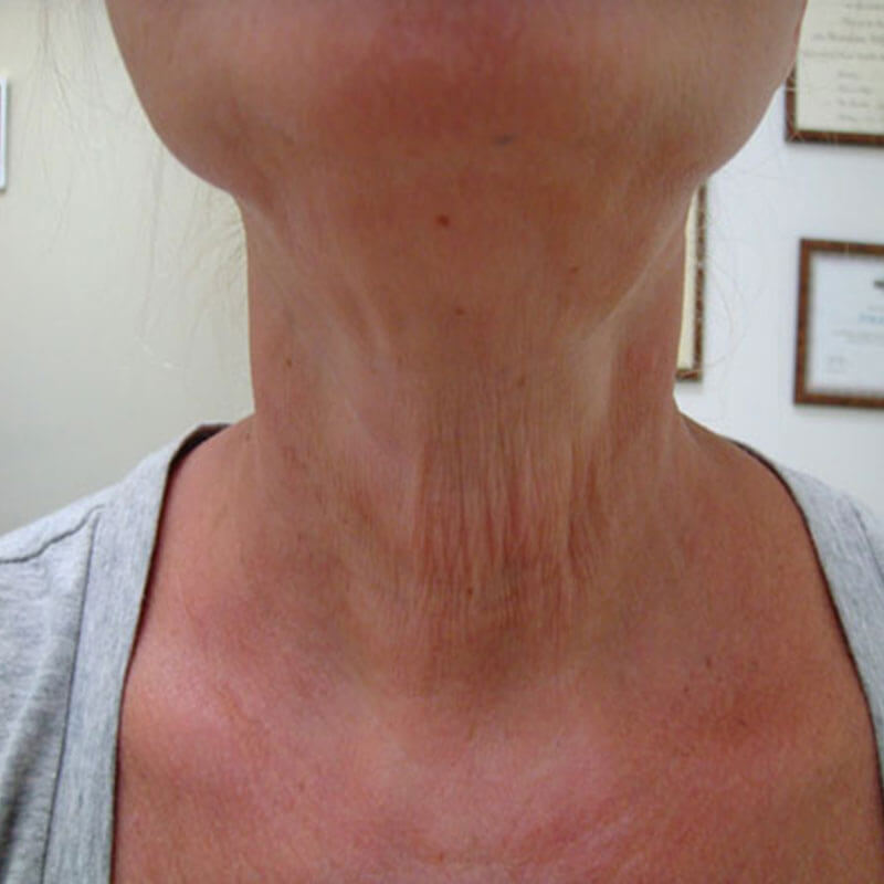 Unidad Láser - LÁSER ELEKTRA BY CLEARLIFT - Antes Cuello - Clínica Dermatológica Daniel Candelas