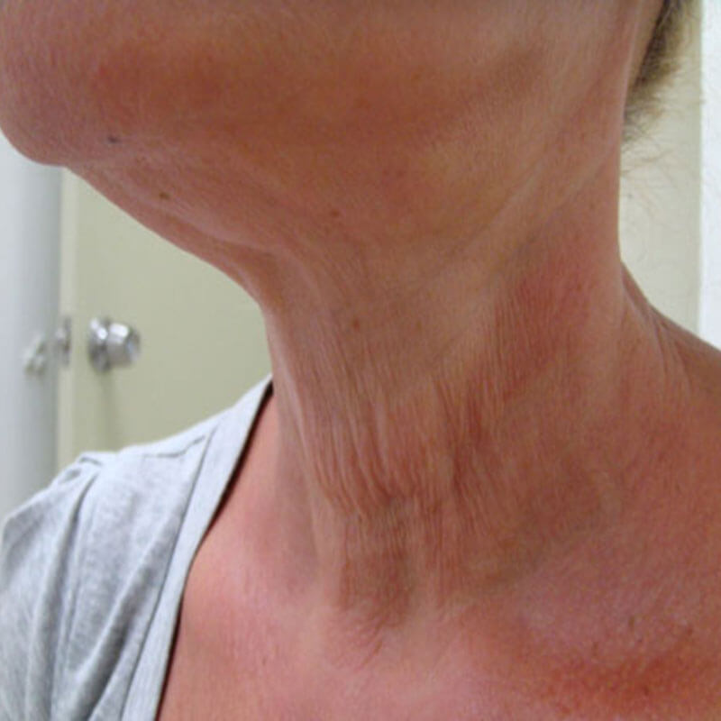 Unidad Láser - LÁSER ELEKTRA BY CLEARLIFT - Antes Cuello - Clínica Dermatológica Daniel Candelas