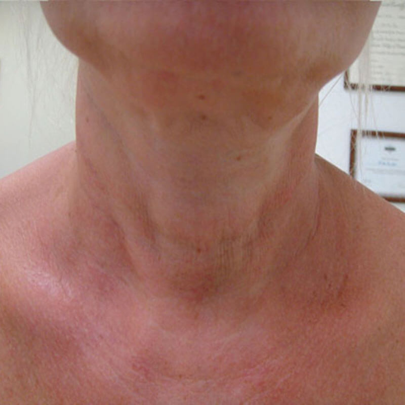 Unidad Láser - LÁSER ELEKTRA BY CLEARLIFT - Después Cuello - Clínica Dermatológica Daniel Candelas