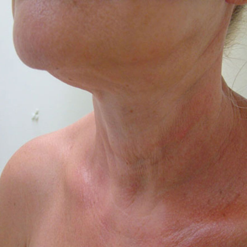 Unidad Láser - LÁSER ELEKTRA BY CLEARLIFT - Después Cuello - Clínica Dermatológica Daniel Candelas